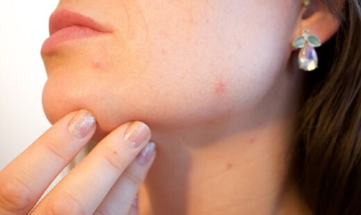 Acne pode aparecer por diversos motivos, muitos deles bastante simples de corrigir. 