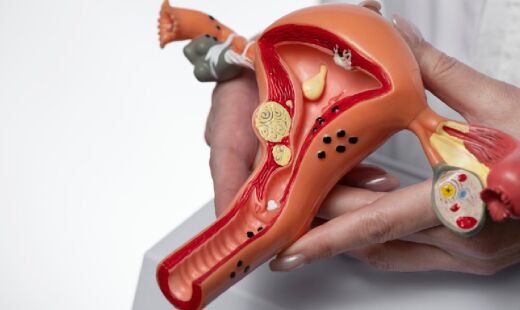 A endometriose é uma doença crônica e benigna onde o tecido semelhante ao endométrio (que reveste o útero) cresce fora do útero, geralmente na cavidade pélvica ou abdominal