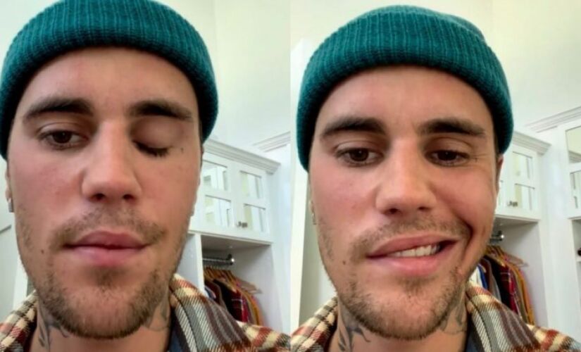 Justin Bieber gravou stories mostrando seu rosto paralisado