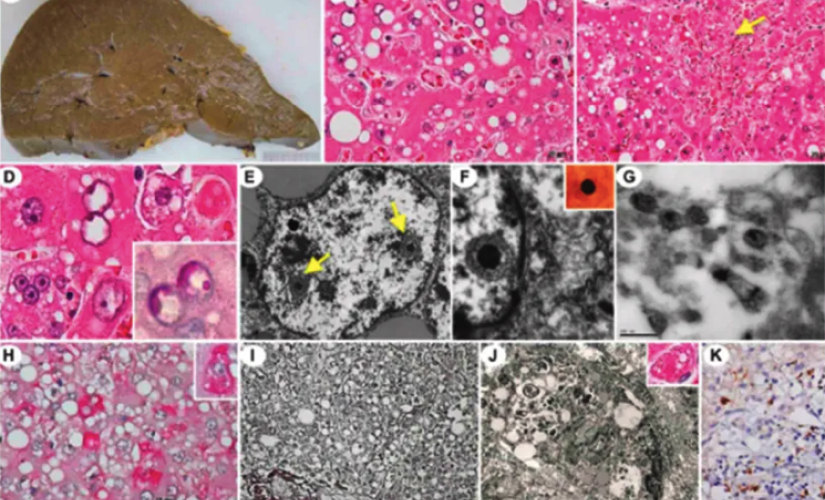 Patologia da infecção grave pelo SABV. Imagens mostram fígado danificado e detalhes do vírus