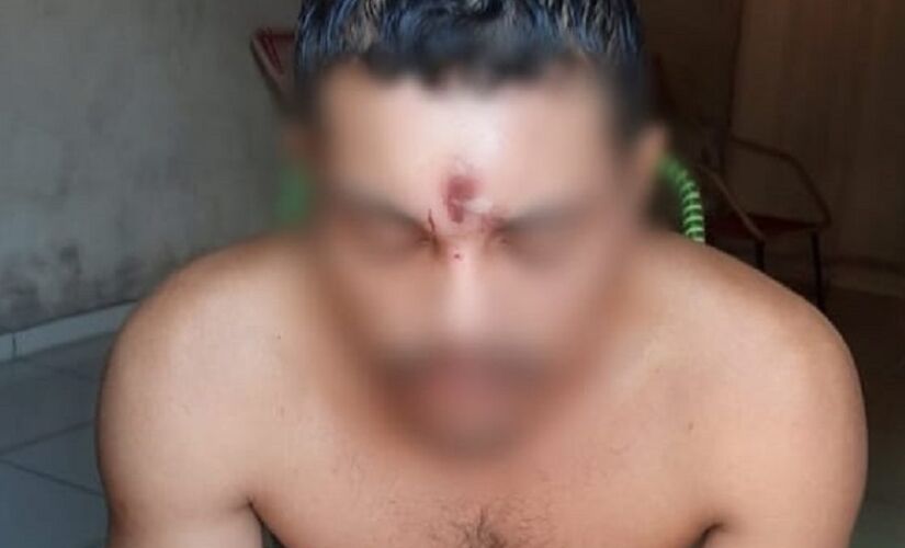 Homem foi baleado na testa e mesmo assim resolveu ir para casa tirar uma soneca