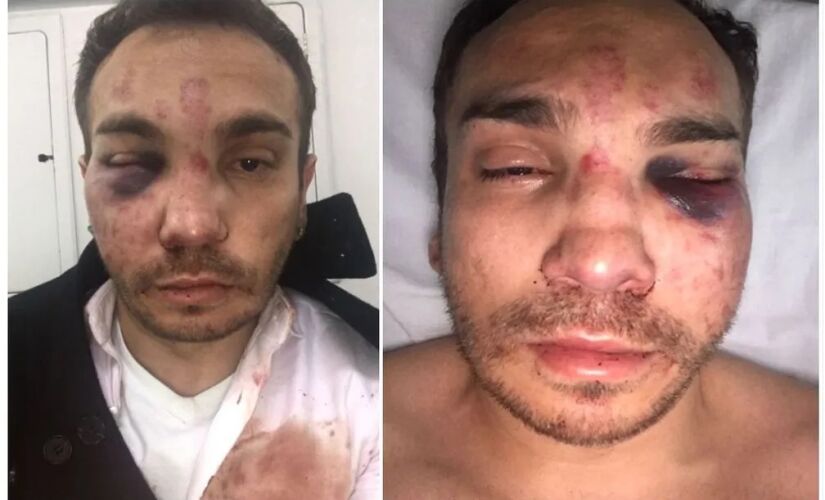 Isaac Lopes Alves conta que sofreu fraturas no rosto após ser agredido por seis seguranças da festa