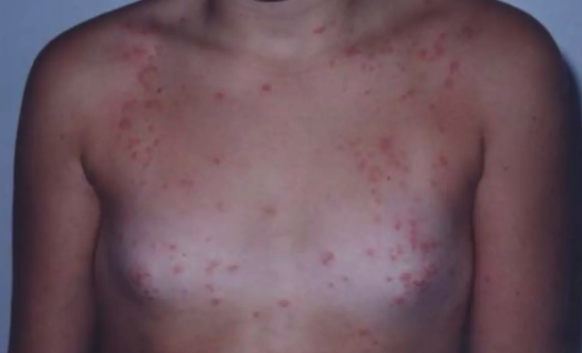 Mostra da dermatite em casos de prurido do traje de banho 