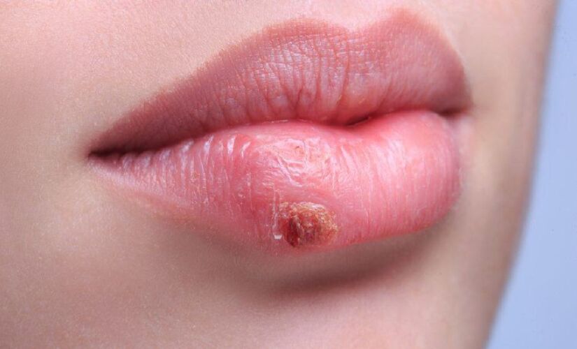 O vírus Herpes simplex tipo 1 é o causador da herpes labial, e muitas pessoas acham que a única forma de trasmição é o beijo, mas especialista aponta outras formas