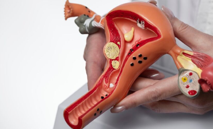 A endometriose é uma doença crônica e benigna onde o tecido semelhante ao endométrio (que reveste o útero) cresce fora do útero, geralmente na cavidade pélvica ou abdominal