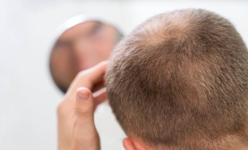 80% dos homens com mais de 80 anos sofrem de calvície, segundo a Sociedade Brasileira de Dermatologia 