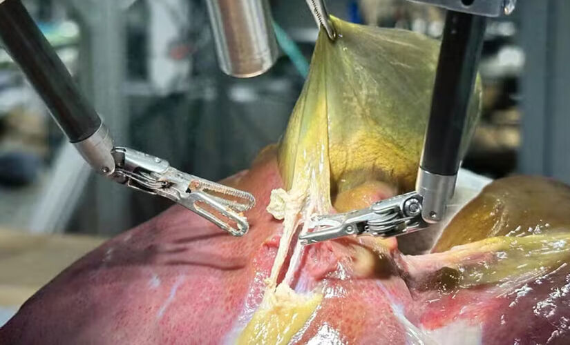 Robô conduzido por IA fez cirurgia em humano
