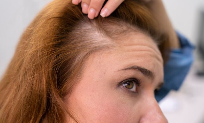 Produto vegetal vira alternativa para combater calvície e queda de cabelo