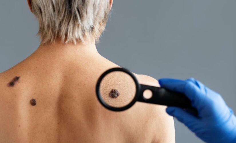 Conheça sua pele e procure um médico se notar um sinal diferente dos outros