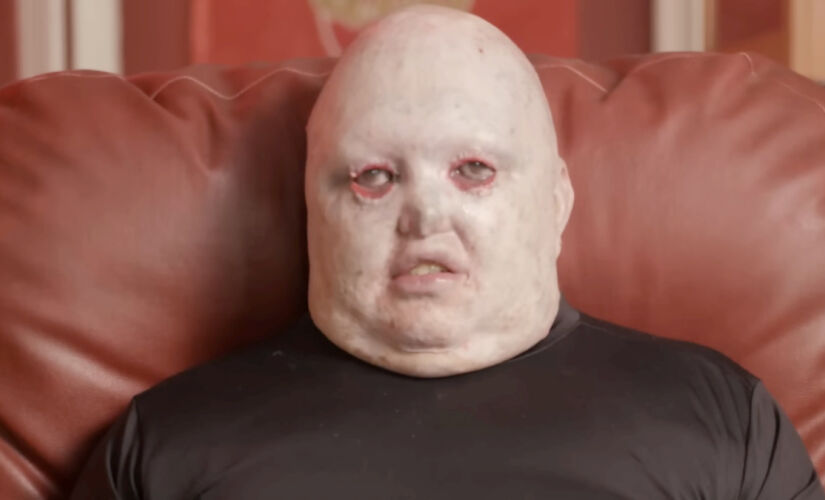 Como a Epidermólise Bolhosa (EB) transformou Danan, ensinando-o a controlar a dor e a quebrar recordes no powerlifting.