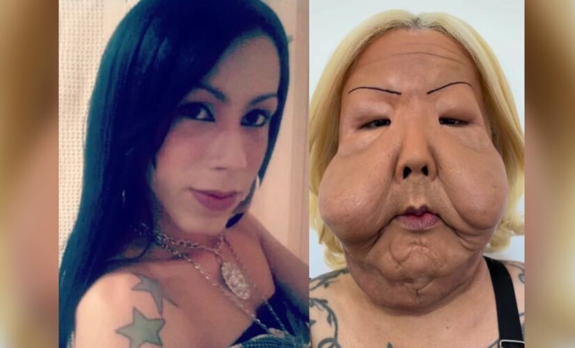 Cirurgia de reparação em 'Juju do Pix' é a primeira de várias