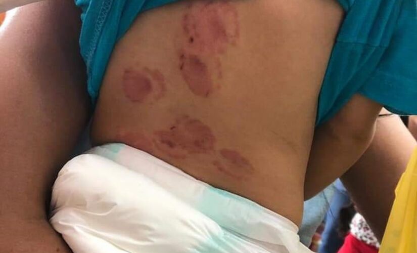 O bebê tinha ao menos 15 marcas de mordidas pelas costas, orelhas, barriga e rosto, segundo a mãe; caso ocorreu na quarta