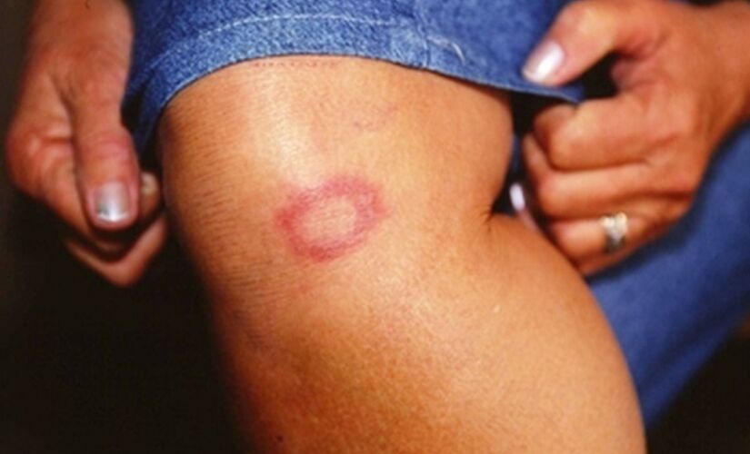 A hanseníase é uma doença infectocontagiosa causada por uma bactéria