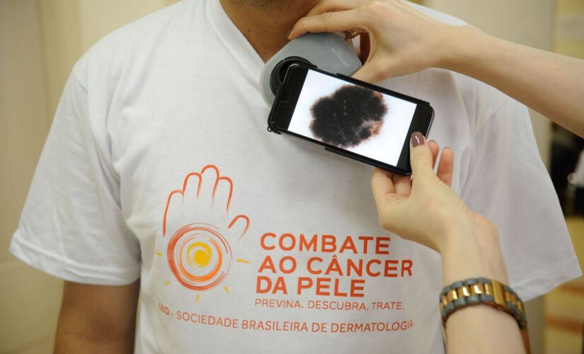 O câncer de pele não melanoma deve permanecer como o mais incidente, com a expectativa de 177 mil novos casos por ano