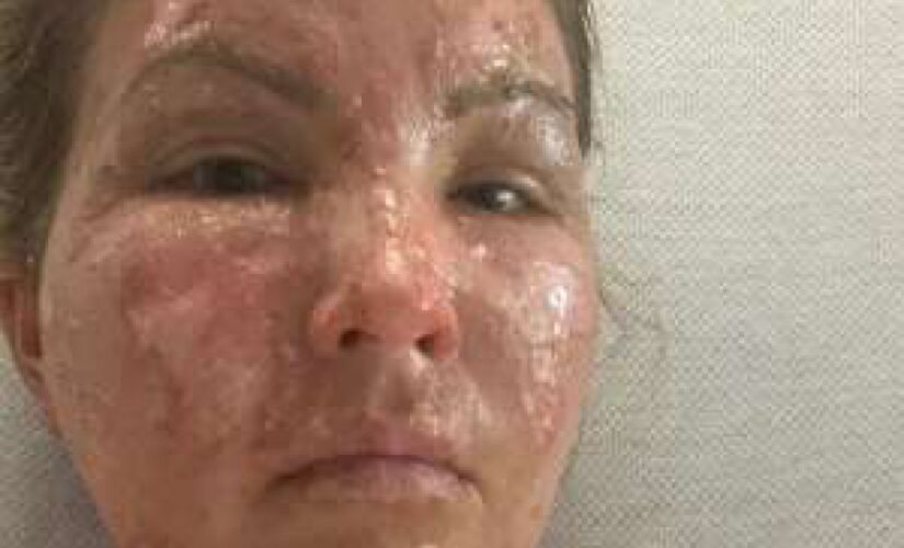 A americana Kate Wise está se recuperando em uma UTI (Unidade de Terapia Intensiva).


