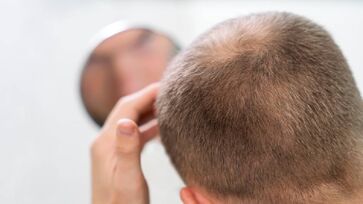 80% dos homens com mais de 80 anos sofrem de calvície, segundo a Sociedade Brasileira de Dermatologia 