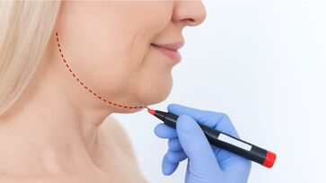 É possível eliminar e prevenir a papada desde uma rotina de alimentação saudável até procedimentos estéticos pouco invasivos