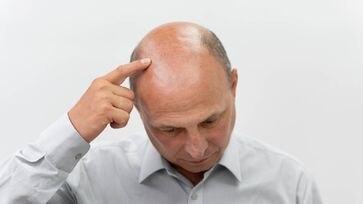 80% dos homens com mais de 80 anos sofrem de calvície, segundo a Sociedade Brasileira de Dermatologia 