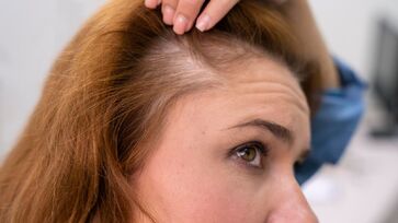 Produto vegetal vira alternativa para combater calvície e queda de cabelo