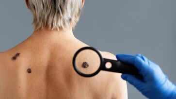 Conheça sua pele e procure um médico se notar um sinal diferente dos outros