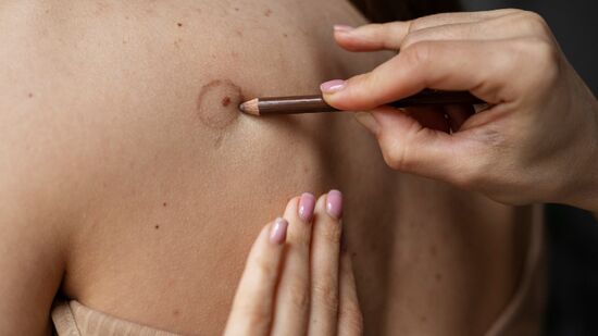 O câncer de pele é o mais comum no Brasil, representando cerca de 33% de todos os diagnósticos oncológicos no País