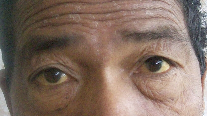 Olhos amarelados são um dos sintomas de doenças no fígado - Foto: Bobjgalindo/Wikimedia Commons