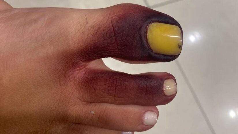O susto começou com a imagem do pé de uma empresária carioca, que ficou roxo após esmagar um piolho-de-cobra dentro do sapato. O caso chamou atenção nas redes sociais e gerou alarme. Foto: Reprodução/Instagram