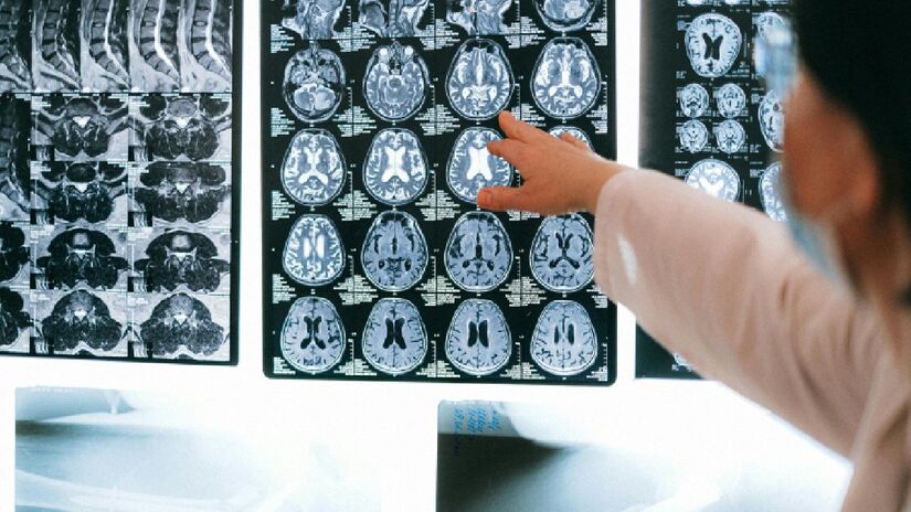 Em janeiro de 2021, uma senhora de 64 anos, no sudeste de Nova Gales do Sul  na Austrália  começou a apresentar dores abdominais, diarreia, febre, tosse e falta de ar. após exames realizados, nenhum parasita foi encontrado no corpo da paciente. Em 2022, a mesma mulher  que não quis ser identificada  começou a ter esquecimentos, dificuldades no processamento do pensamento e depressão. Foi então que uma ressonância magnética revelou uma "lesão atípica" em seu cérebro.

Foto: Reprodução/Pexels