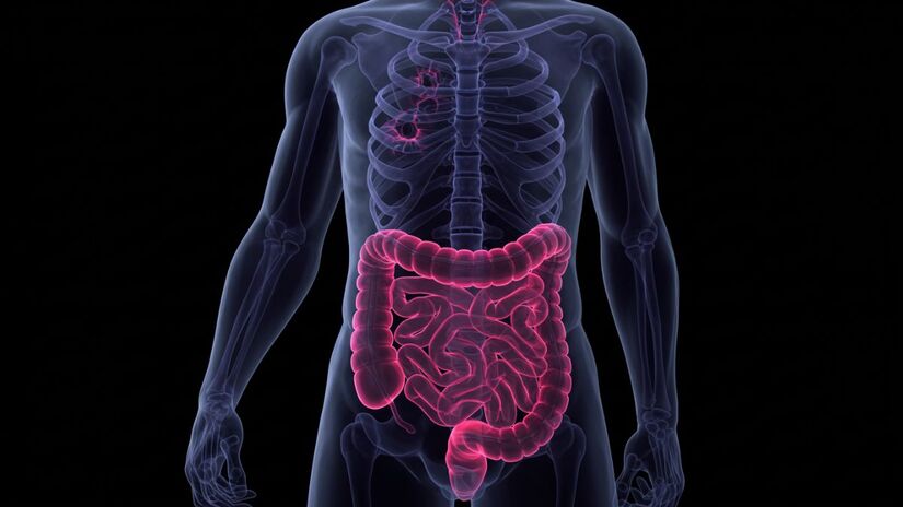 Conservantes e aromatizantes intensificam o risco e podem mascarar problemas mais sérios no intestino (Imagem gerada por IA) 