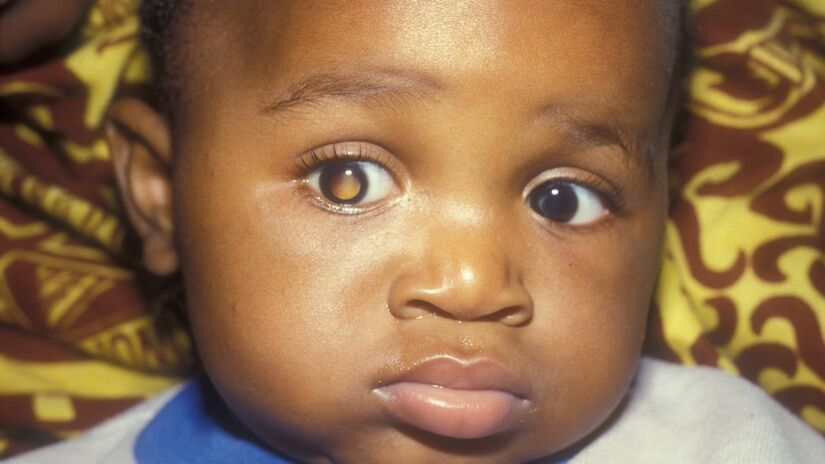 Crianças com retinoblastoma desenvolvem uma área branca e opaca na pupila, que se chama leucocoria, causada pela reflexão da luz provocada pela doença.