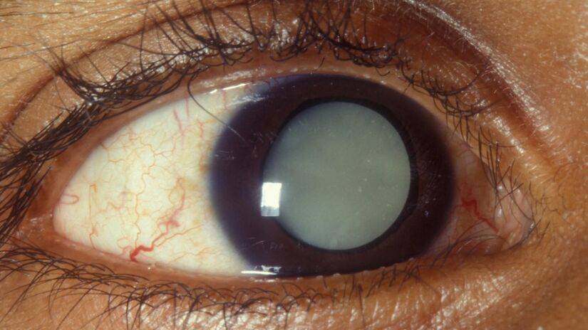 Entre os exames por imagem estão ultrassonografia do globo ocular, tomografia e ressonância magnética das órbitas oculares. Fotos: Reprodução/Flickr