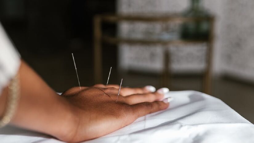 A técnica faz parte da medicina tradicional chinesa e consiste na aplicação de instrumentos em forma de agulhas em pontos determinados do corpo, assim promovendo a liberação de substâncias como endorfina e serotonina e reduzindo a liberação de adrenalina e cortisol - (RDNE Stock project/Pexels)