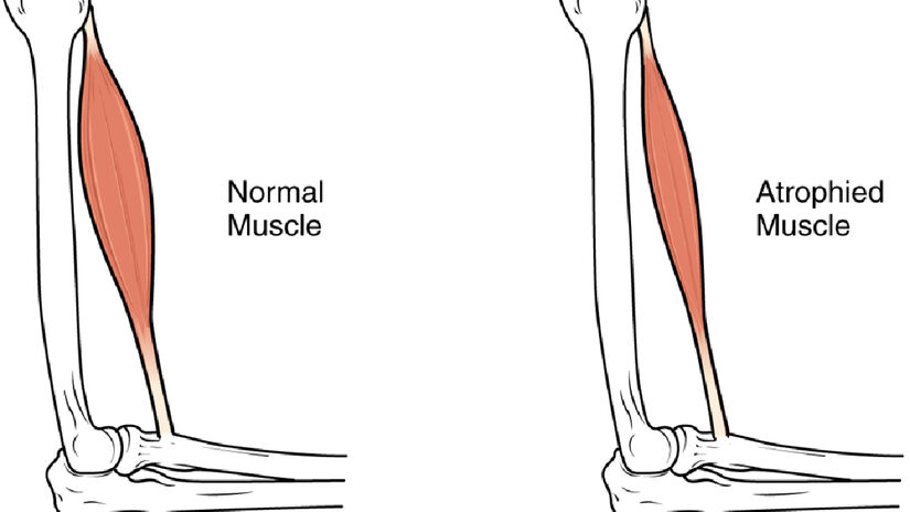 Esquema da sarcopenia, condição que atrofia os músculos conforme a idade avança. Imagem: OpenStax/Wikimedia Commons