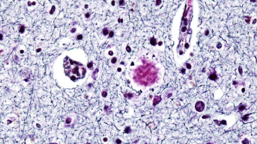 Alzheimer é causado pelo acúmulo de placas de proteína nas células cerebrais. Imagem: User:KGH/Wikimedia Commons