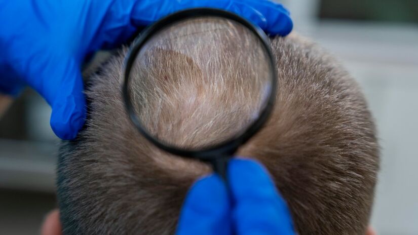 Hoje, o método mais usado é o transplante capilar, no qual fios do próprio paciente são implantados nas partes da cabeça onde eles não crescem mais (Fotos: Freepik)