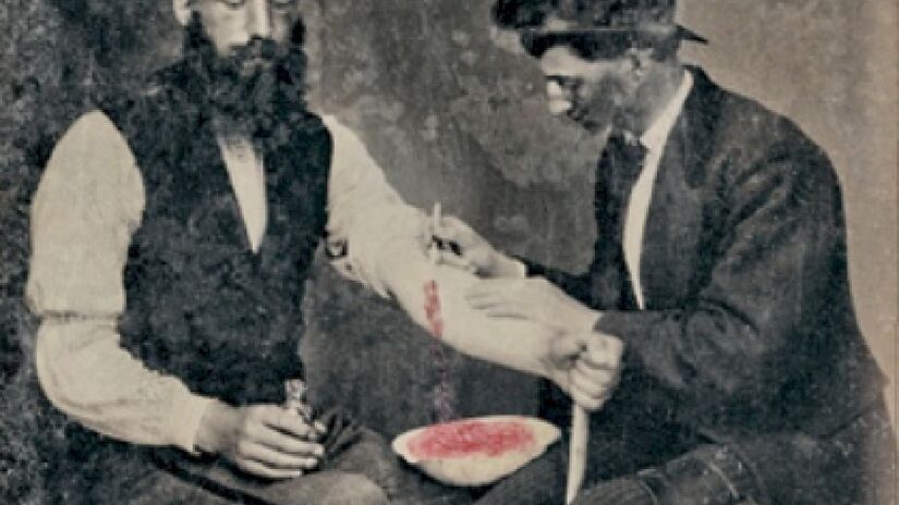 Durante a sangria os pacientes seguravam um bastão para manter o sangue fluindo. Imagem: Domínio Público