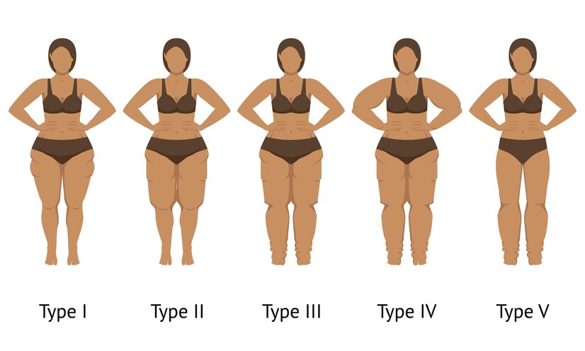 Os tipos de lipedema