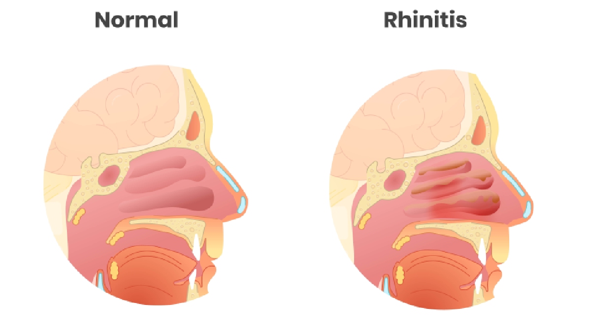 Rinite 