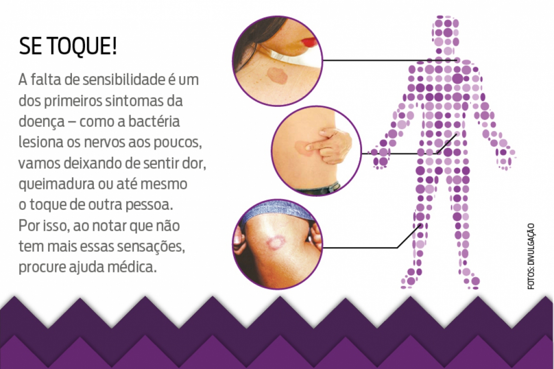 Ministério da Saúde 🩵 on X: Você sabe os sinais e sintomas da Hanseníase?  Aprenda com essa reportagem do #BlogDaSaúde:    / X