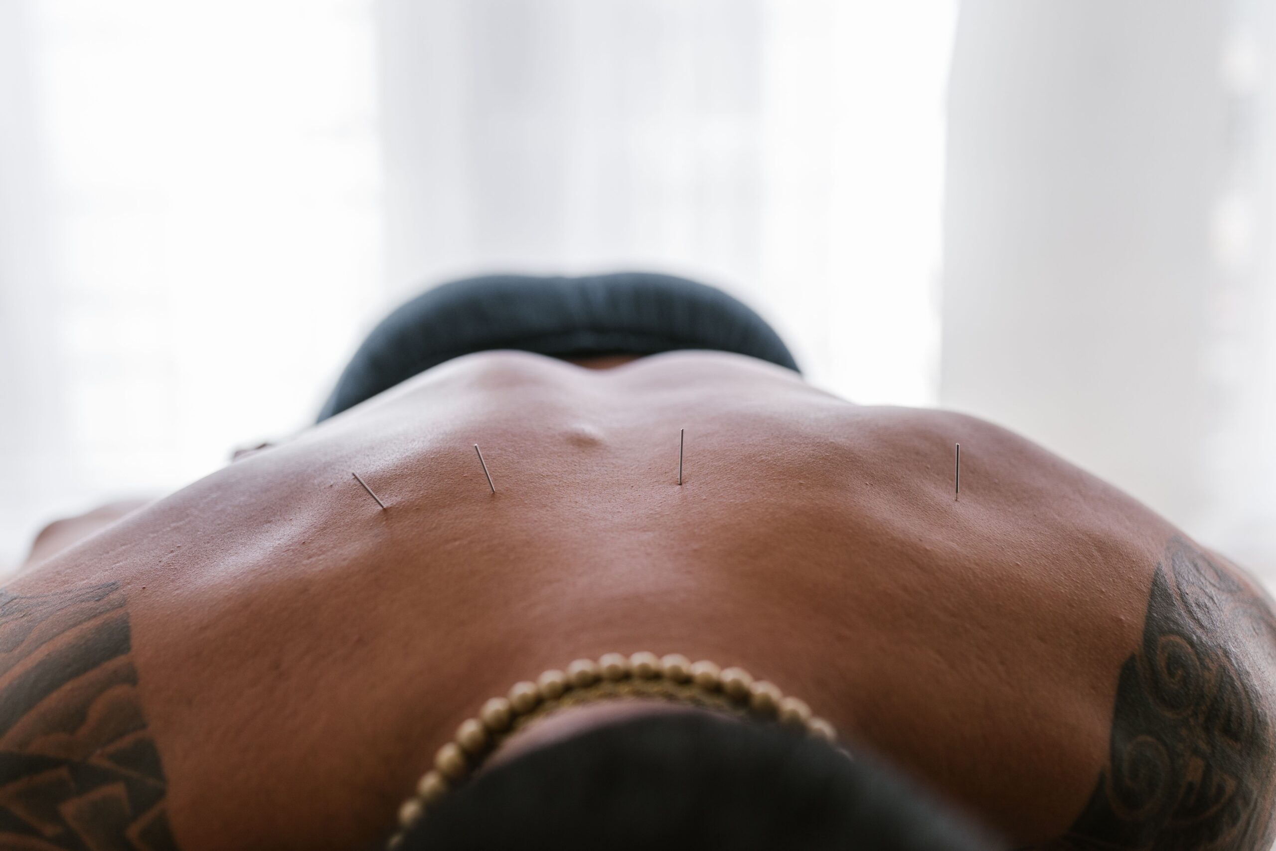 Utilizada como terapia complementar, a acupuntura pode contribuir para melhorar a qualidade de vida de pessoas com dores persistentes (Foto: Pexels)