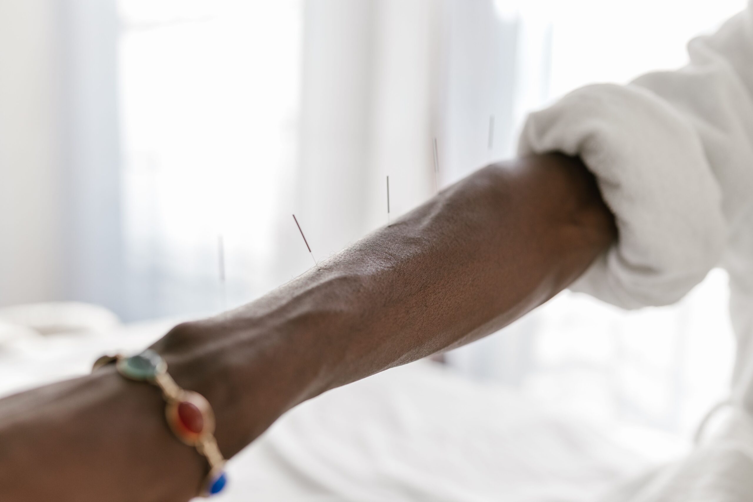 A ciência investiga como a acupuntura altera a percepção da dor ao estimular diferentes regiões do cérebro (Foto: Pexels)