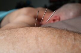 A acupuntura estimula pontos específicos do corpo que podem ajudar a modular a dor e promover sensação de bem-estar (Foto: Pexels)