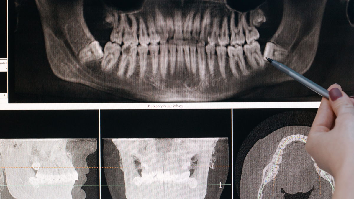 Embora tenha perdido sua função original ao longo da evolução humana, o siso continua presente em grande parte da população (Foto: Pexels)