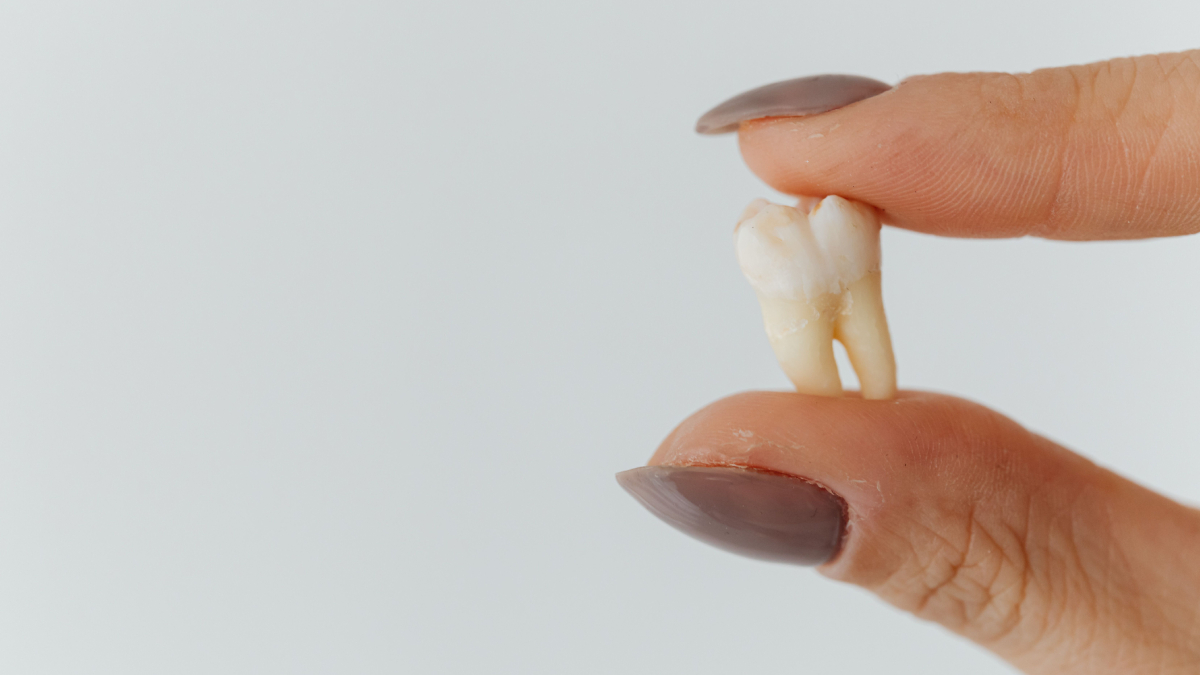 O dente do siso costuma surgir entre os 17 e os 25 anos e nem sempre precisa ser extraído (Foto: Pexels)