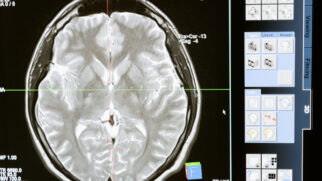 Pesquisa aponta que a proteína tau pode ser a principal responsável pela progressão do Alzheimer (Foto: MART PRODUCTION/ Pexels)