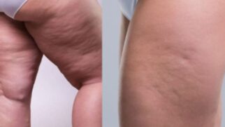 lipedema