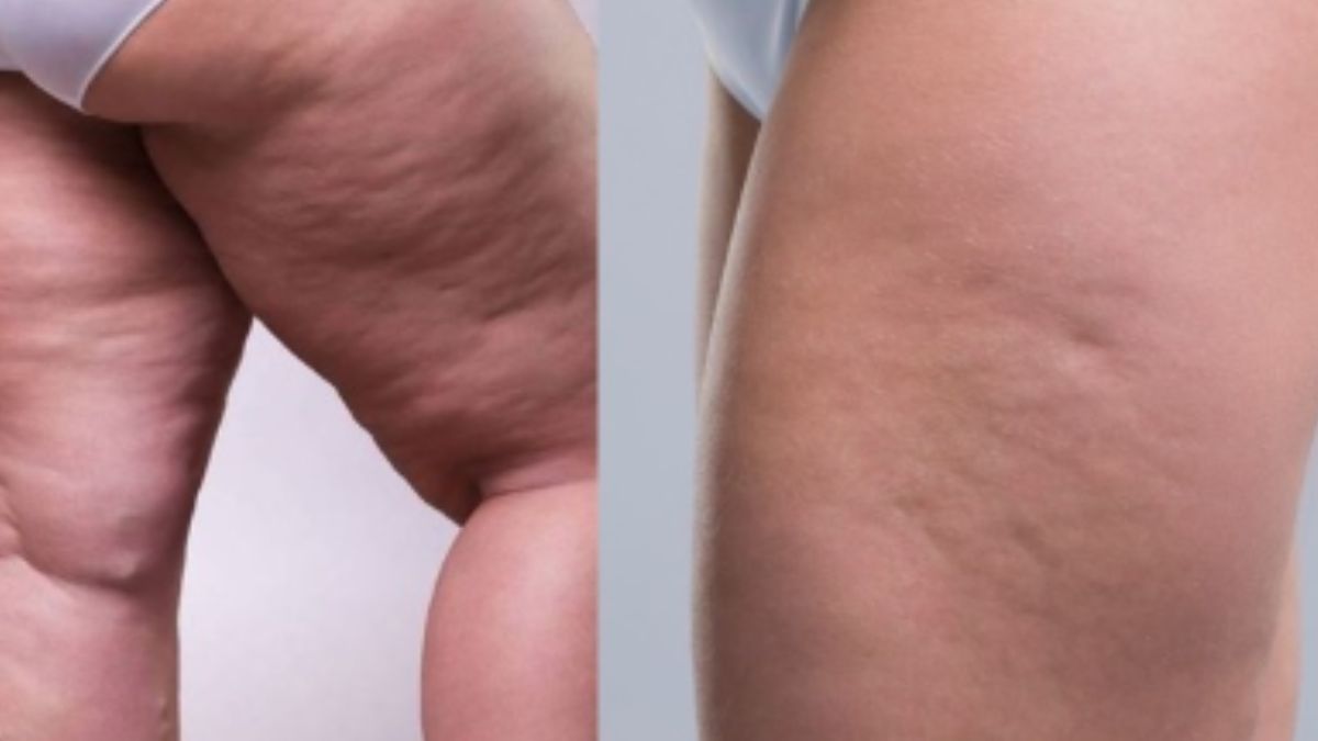 lipedema