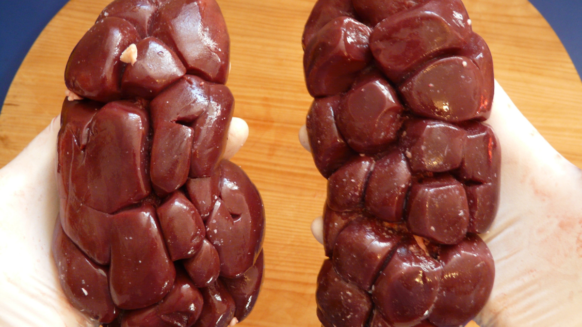 A doença renal crônica costuma evoluir sem sintomas nas fases iniciais, reforçando a importância dos exames preventivos (Foto: Hans/ Pixabay)