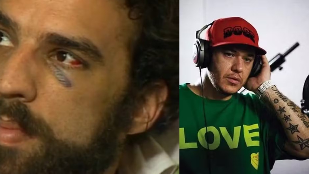 Marcelo Camelo com olho roxo após tomar cabeçada de Chorão