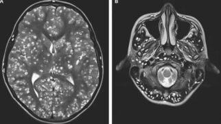 Exame mostra os nódulos causados por ovos de parasitas em cérebro de jovem indiano. (Foto: ESIC Medical College/Divulgação)